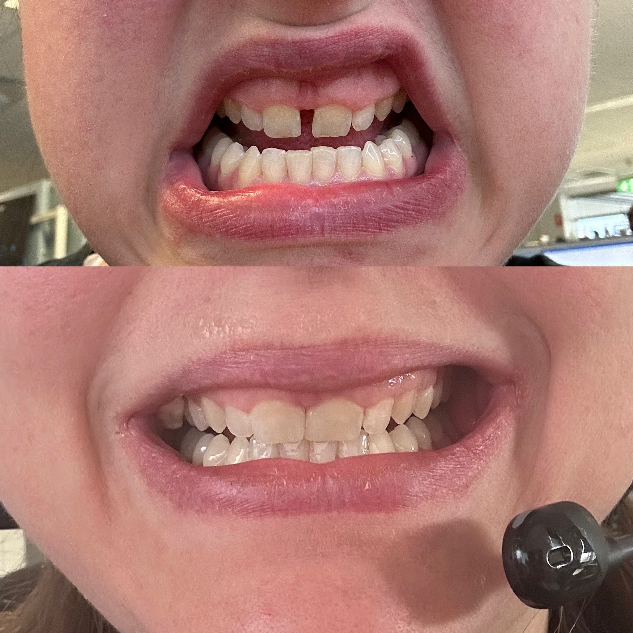 Before and after dental bonding